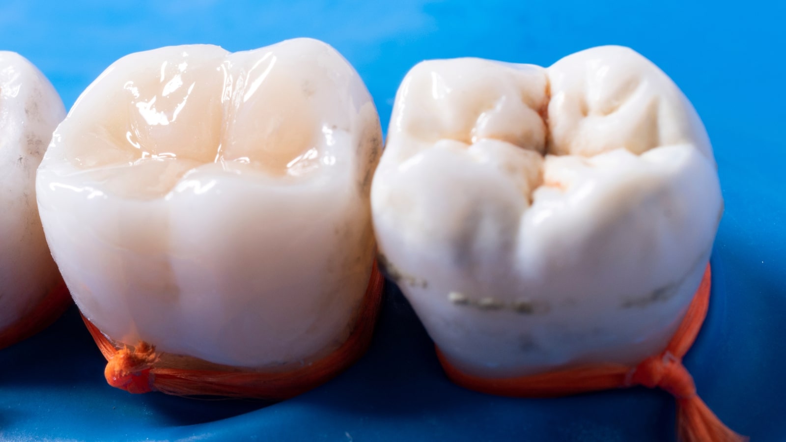 composite fillings richmond