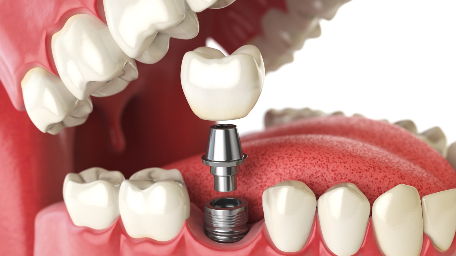 dental implants richmond