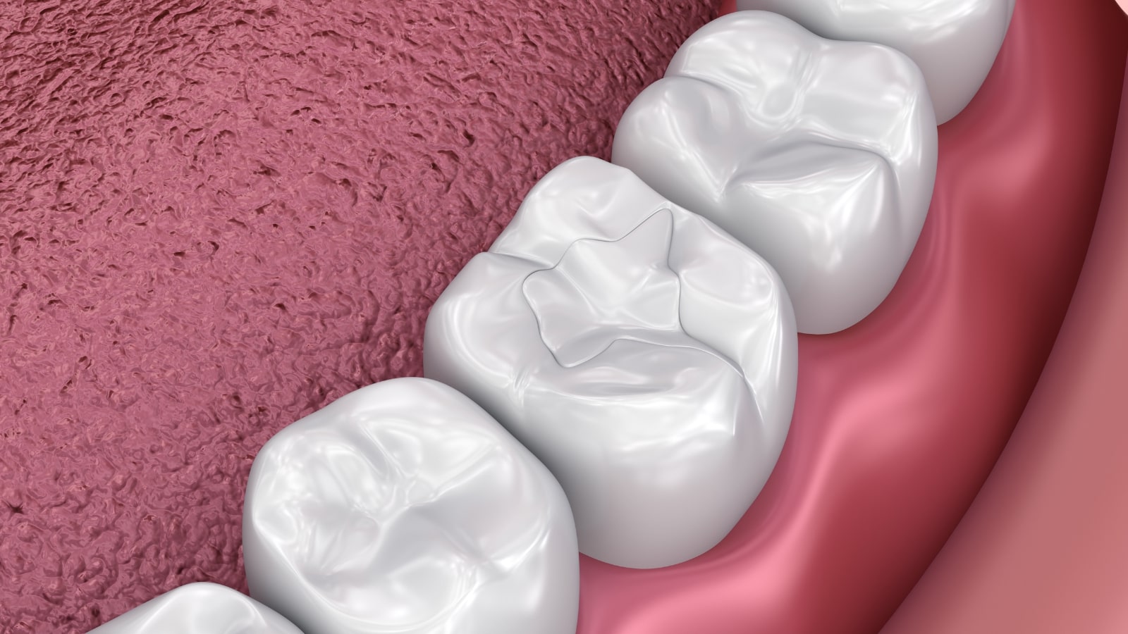 dental sealants richmond