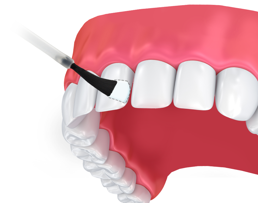 fluoride treatment richmond