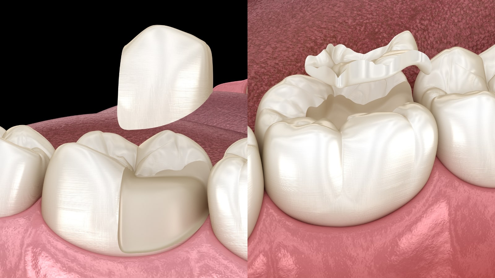 porcelain inlays and onlays richmond