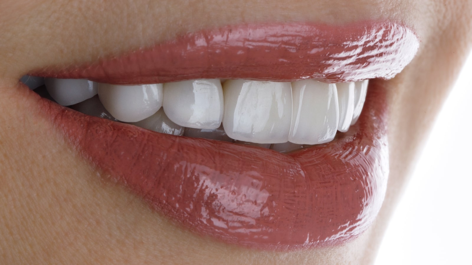 porcelain veneers richmond